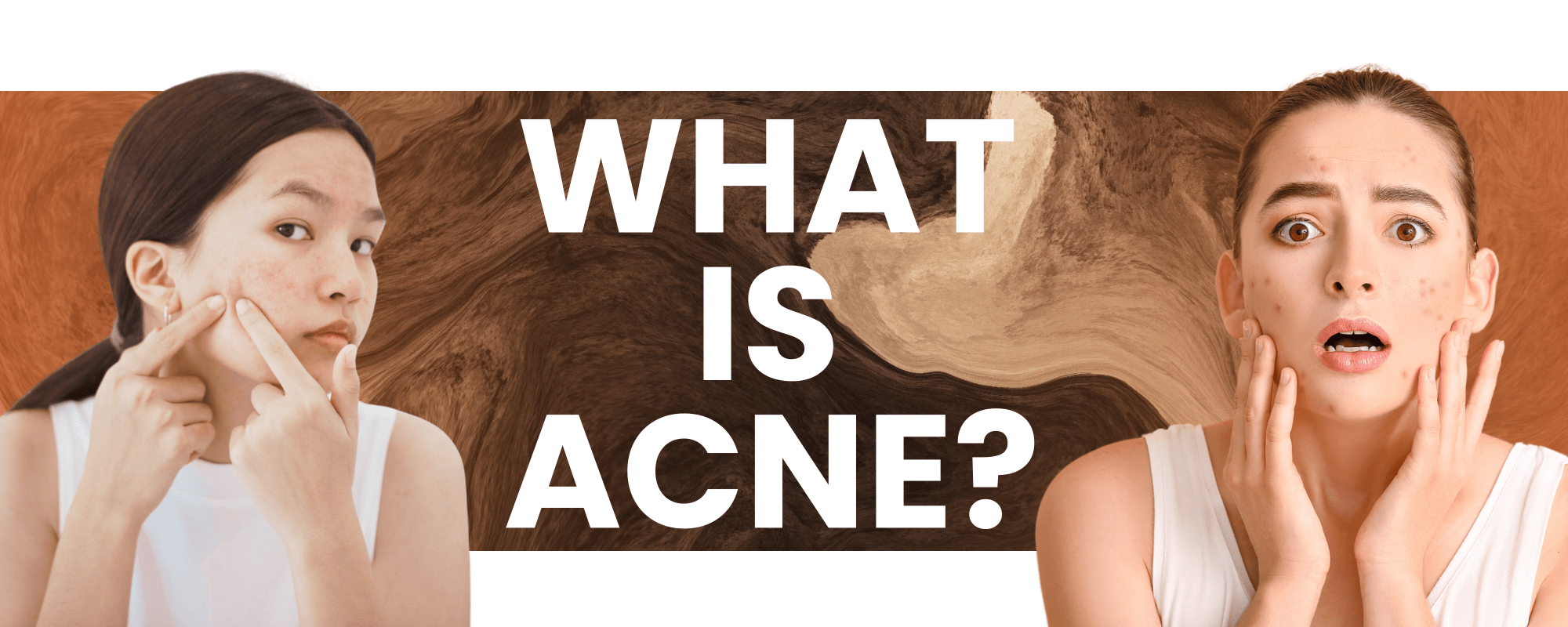 Know About Acne & Effective Treatments - The Fonz - Le Charme
